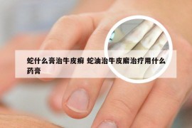 蛇什么膏治牛皮癣 蛇油治牛皮廨治疗用什么药膏