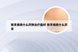 银宵病用什么药物治疗最好 银宵病用什么药膏