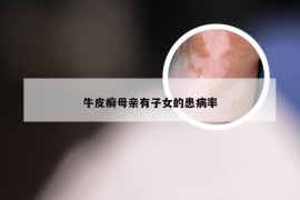 牛皮癣母亲有子女的患病率