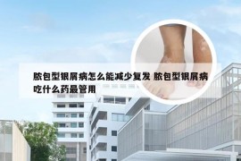 脓包型银屑病怎么能减少复发 脓包型银屑病吃什么药最管用