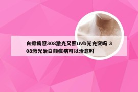 白癫疯照308激光又照uvb光充突吗 308激光治白颠疯病可以治愈吗