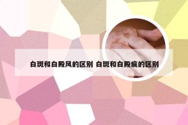 白斑和白殿风的区别 白斑和白殿疯的区别