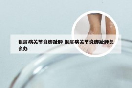 银屑病关节炎脚趾肿 银屑病关节炎脚趾肿怎么办