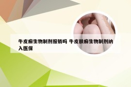 牛皮癣生物制剂报销吗 牛皮肤癣生物制剂纳入医保