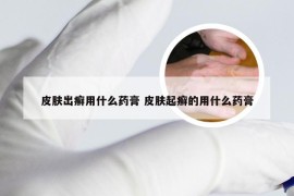 皮肤出癣用什么药膏 皮肤起癣的用什么药膏