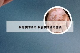 银屑病传染不 银屑病传染不传染