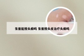 生姜能擦头癣吗 生姜擦头皮治疗头癣吗