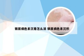 银屑病色素沉着怎么消 银屑病色素沉积