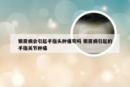 银屑病会引起手指头肿痛弯吗 银屑病引起的手指关节肿痛