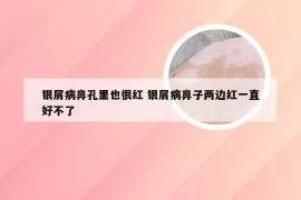 银屑病鼻孔里也很红 银屑病鼻子两边红一直好不了