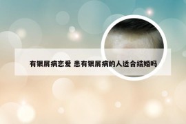 有银屑病恋爱 患有银屑病的人适合结婚吗