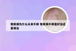 银屑病为什么从来不痒 银屑病不痒是好治还是难治