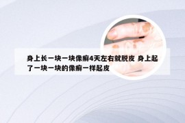 身上长一块一块像癣4天左右就脱皮 身上起了一块一块的像癣一样起皮