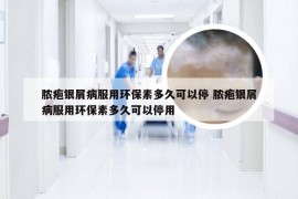 脓疱银屑病服用环保素多久可以停 脓疱银屑病服用环保素多久可以停用