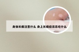 身体长癣注意什么 身上长癣应该忌吃什么