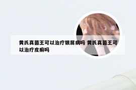 黄氏真菌王可以治疗银屑病吗 黄氏真菌王可以治疗皮癣吗