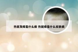 热就发痒是什么癣 热就痒是什么皮肤病