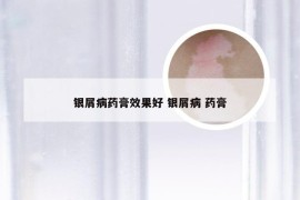 银屑病药膏效果好 银屑病 药膏