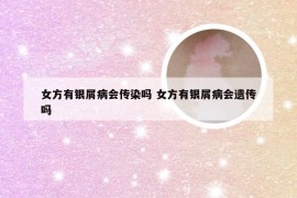 女方有银屑病会传染吗 女方有银屑病会遗传吗