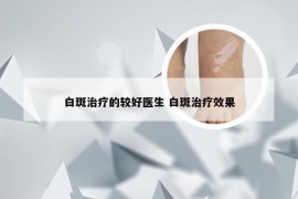 白斑治疗的较好医生 白斑治疗效果