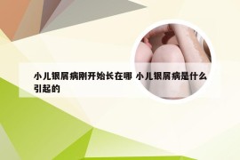 小儿银屑病刚开始长在哪 小儿银屑病是什么引起的