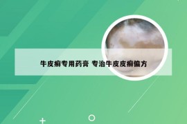 牛皮癣专用药膏 专治牛皮皮癣偏方