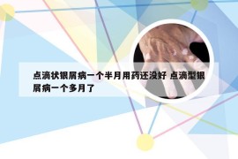 点滴状银屑病一个半月用药还没好 点滴型银屑病一个多月了