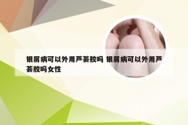 银屑病可以外用芦荟胶吗 银屑病可以外用芦荟胶吗女性