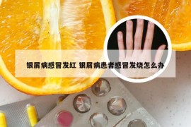 银屑病感冒发红 银屑病患者感冒发烧怎么办