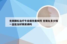 克银颗粒治疗牛皮癣效果如何 克银丸多少钱一盒能治好银屑病吗