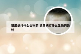 银屑病打什么生物药 银屑病打什么生物药最好