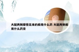 大腿两侧摩擦出来的癣用什么药 大腿两侧癣用什么药膏