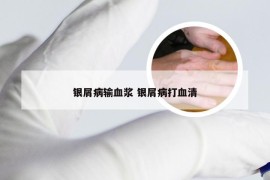 银屑病输血浆 银屑病打血清