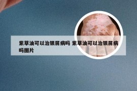 紫草油可以治银屑病吗 紫草油可以治银屑病吗图片