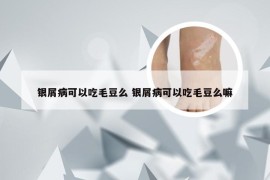 银屑病可以吃毛豆么 银屑病可以吃毛豆么嘛