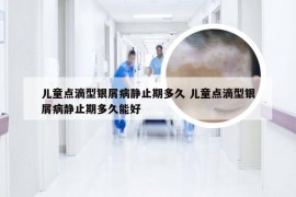 儿童点滴型银屑病静止期多久 儿童点滴型银屑病静止期多久能好