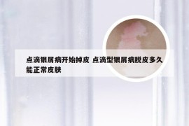 点滴银屑病开始掉皮 点滴型银屑病脱皮多久能正常皮肤