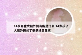 14岁男童大腿外侧有癣是什么 14岁孩子大腿外侧长了很多红色花纹