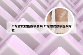 广东省皮肤医院银屑病 广东省皮肤病医院专家