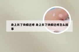 身上长了块癣还疼 身上长了块癣还疼怎么回事