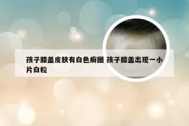 孩子膝盖皮肤有白色癣图 孩子膝盖出现一小片白粒