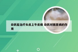 白矾能治疗头皮上牛皮癣 白矾对银屑病的作用