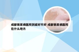 成都银屑病医院到底好不好 成都银屑病医院在什么地方