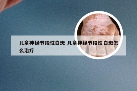 儿童神经节段性白斑 儿童神经节段性白斑怎么治疗