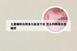 儿童糠疹白斑多久能消下去 怎么判断是白色糠疹