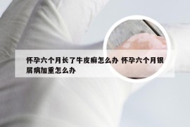 怀孕六个月长了牛皮癣怎么办 怀孕六个月银屑病加重怎么办