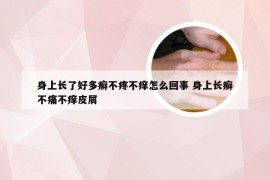 身上长了好多癣不疼不痒怎么回事 身上长癣不痛不痒皮屑