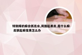 特别痒的癣会抓出水,周围起黑皮,是什么癣 皮肤起癣变黑怎么办