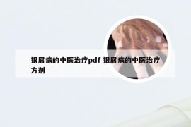 银屑病的中医治疗pdf 银屑病的中医治疗方剂