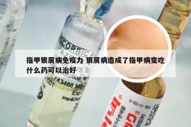 指甲银屑病免疫力 银屑病造成了指甲病变吃什么药可以治好